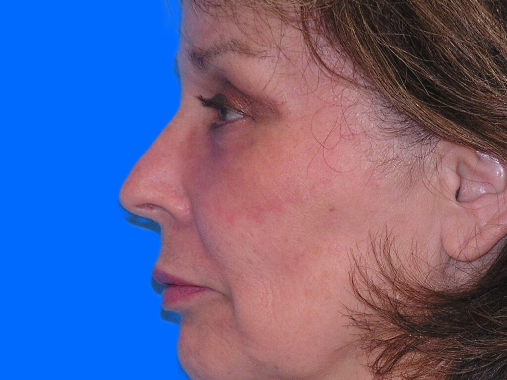 After Image: Patient Case #49 - left-side