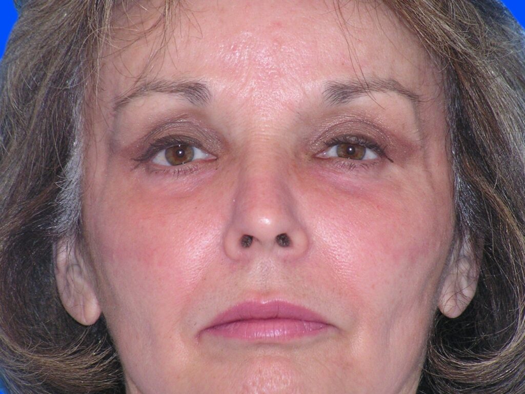 After Image: Patient Case #49 - front