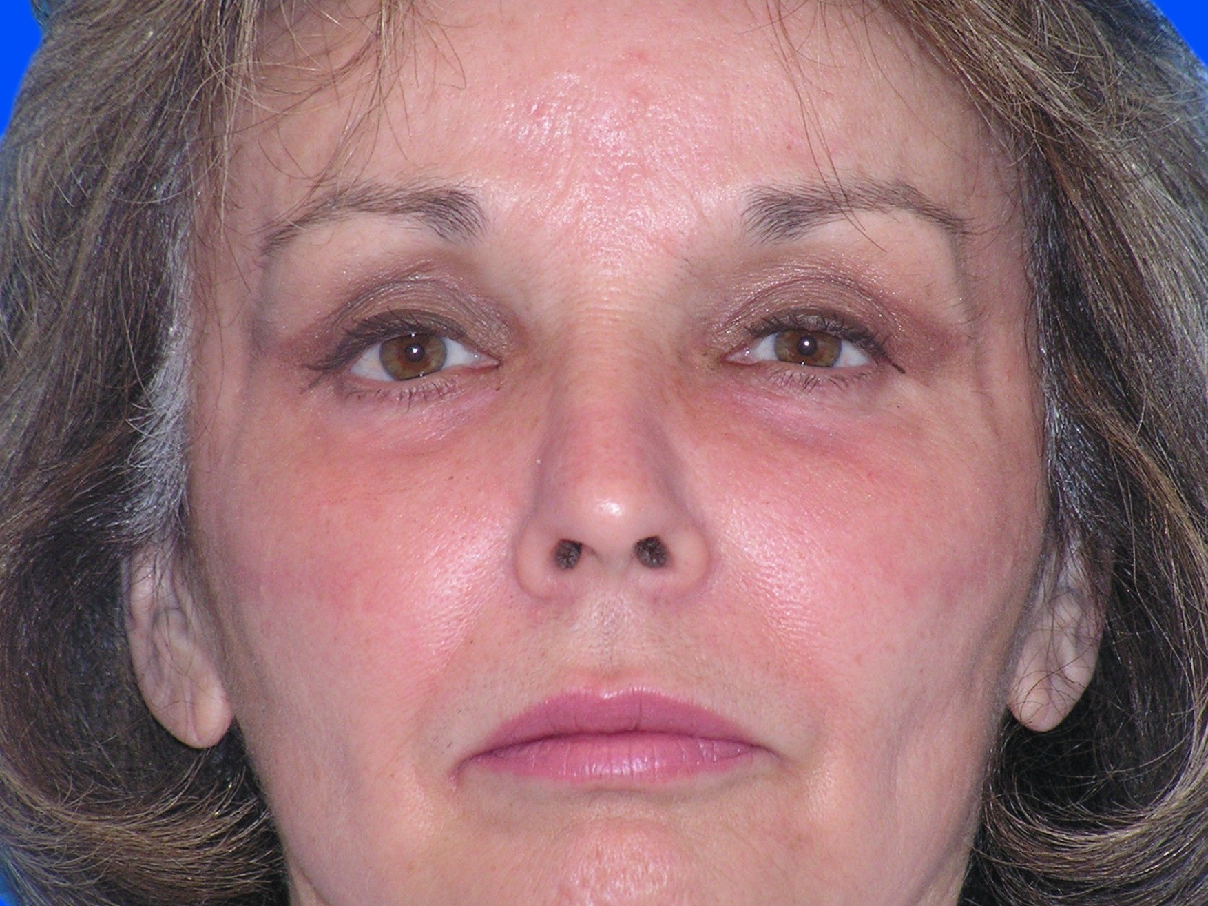 After Image: Patient Case #49 - front