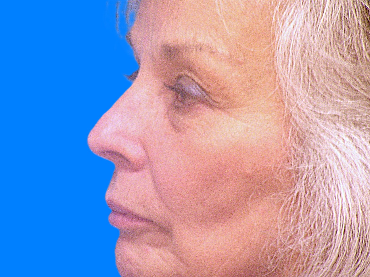 Before Image: Patient Case #49 - left-side