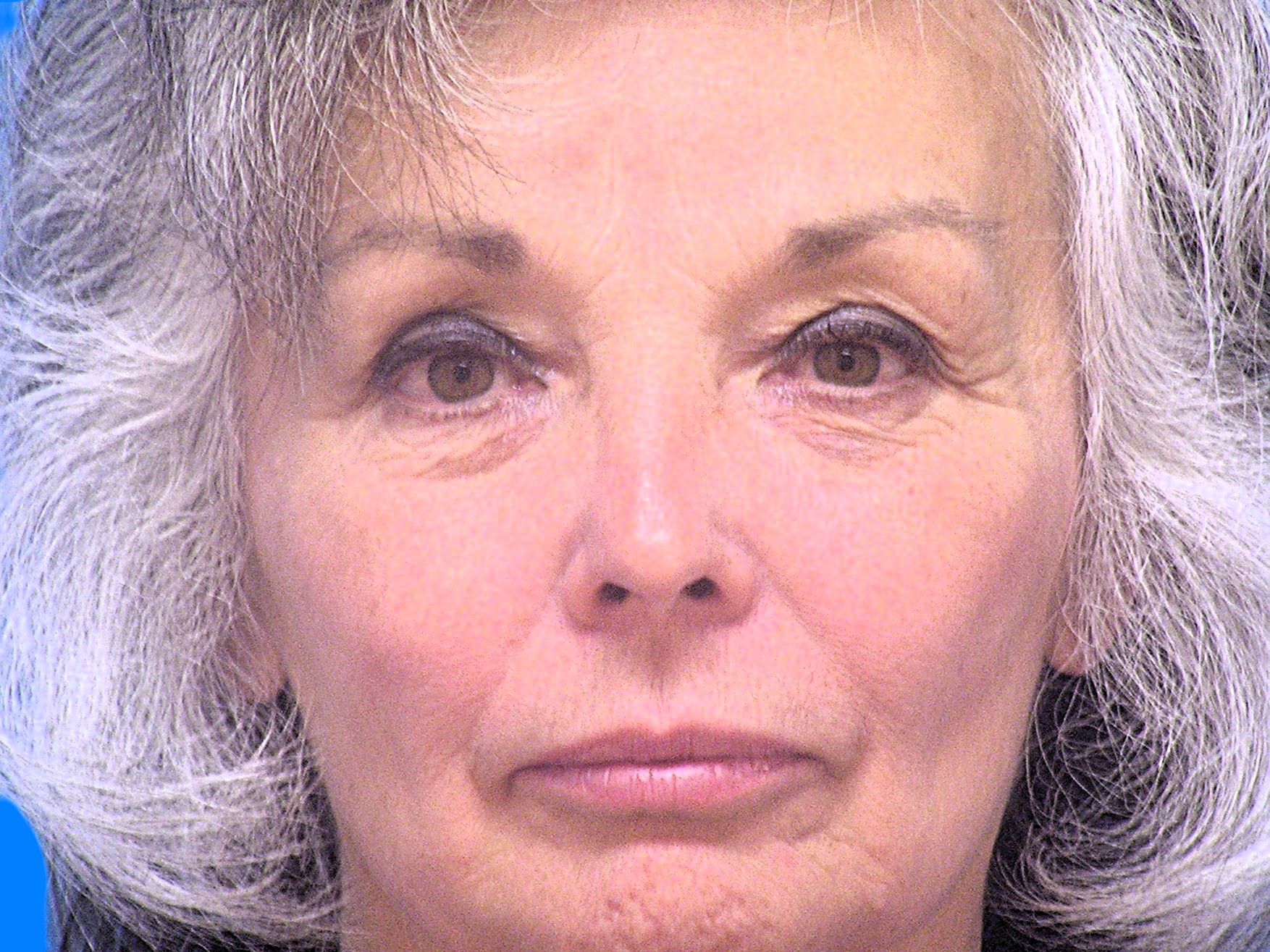 Before Image: Patient Case #49 - front