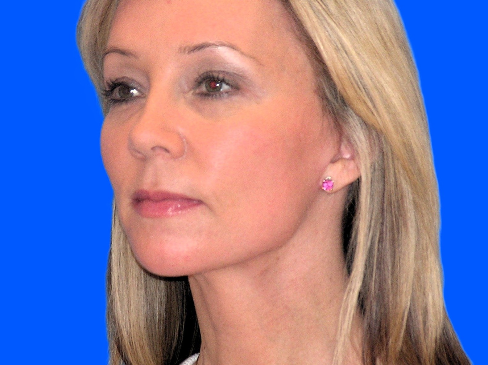 After Image: Patient Case #53 - left-front-oblique