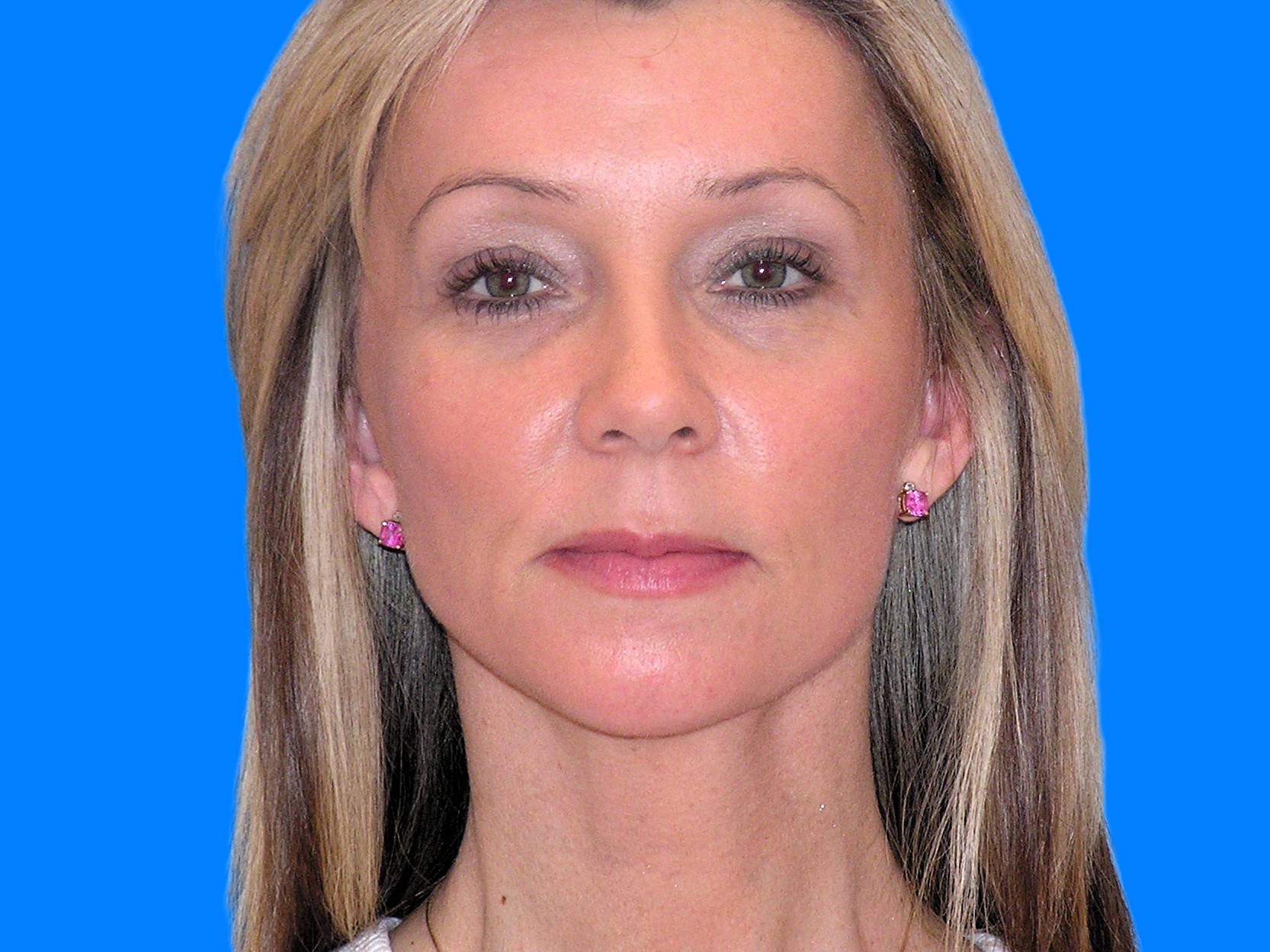 After Image: Patient Case #53 - front