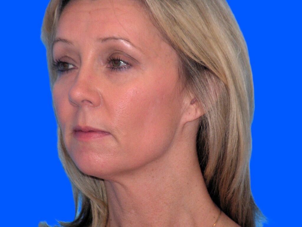 Before Image: Patient Case #53 - left-front-oblique