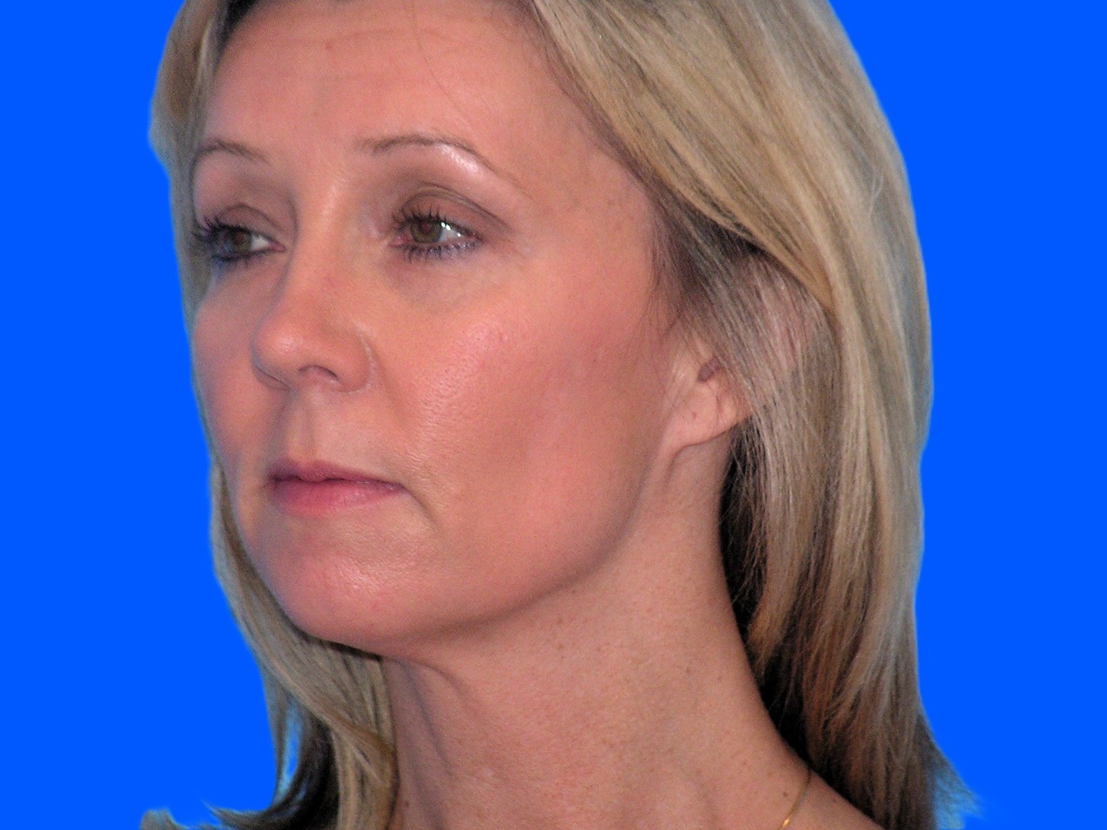 Before Image: Patient Case #53 - left-front-oblique