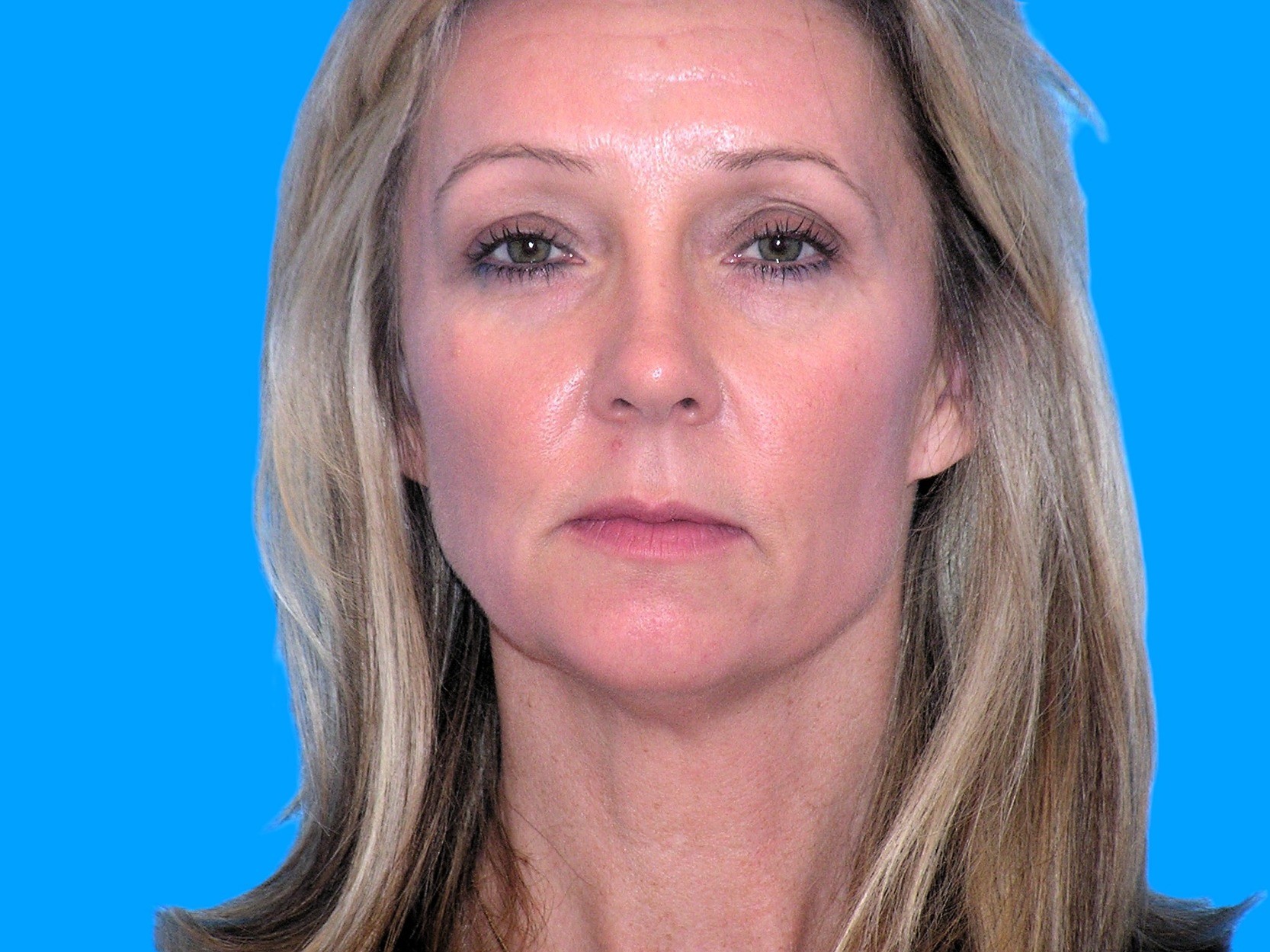 Before Image: Patient Case #53 - front