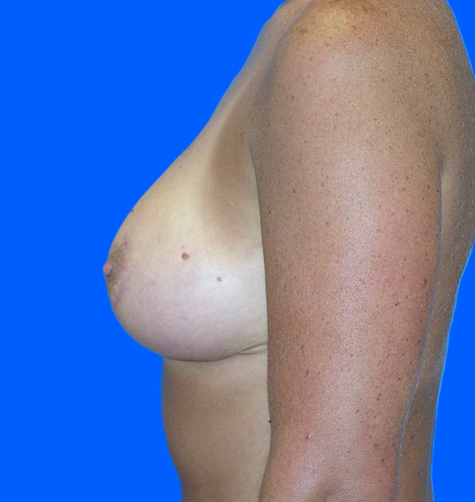 After Image: Patient Case #535 - left-side