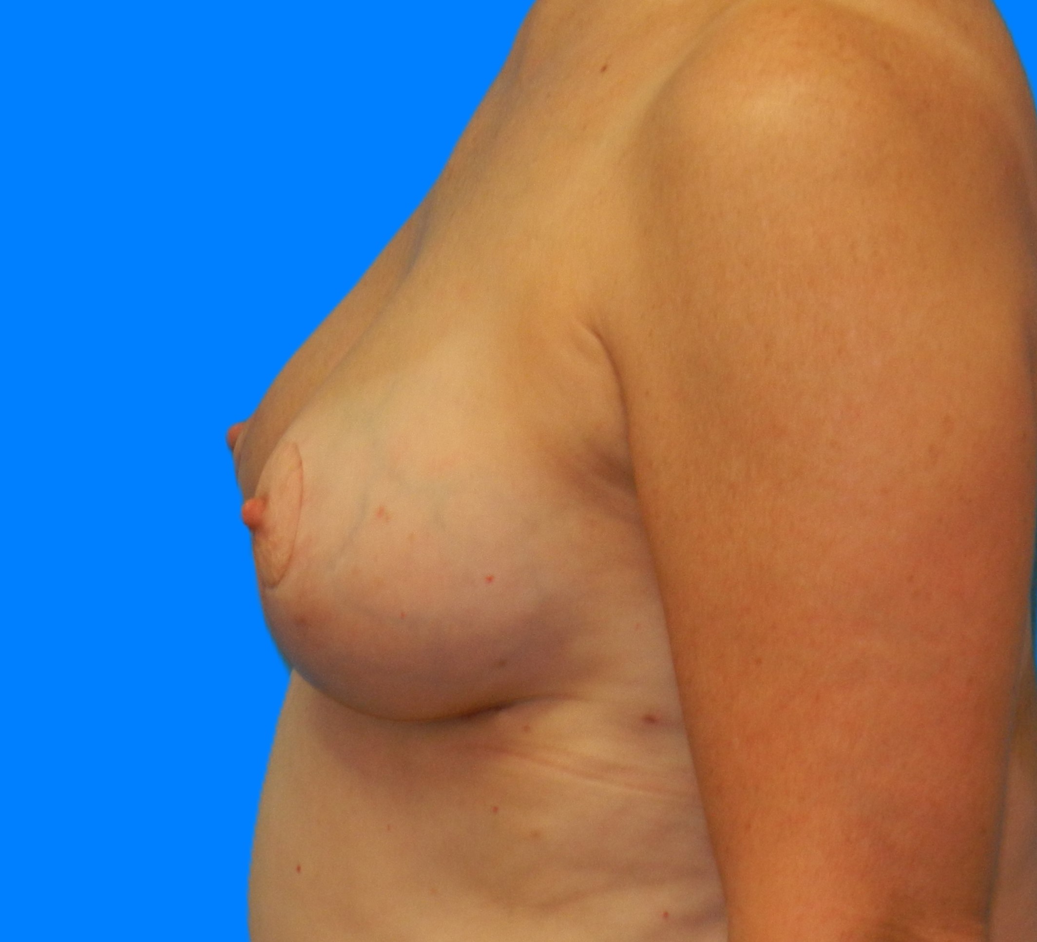 After Image: Patient Case #537 - left-side