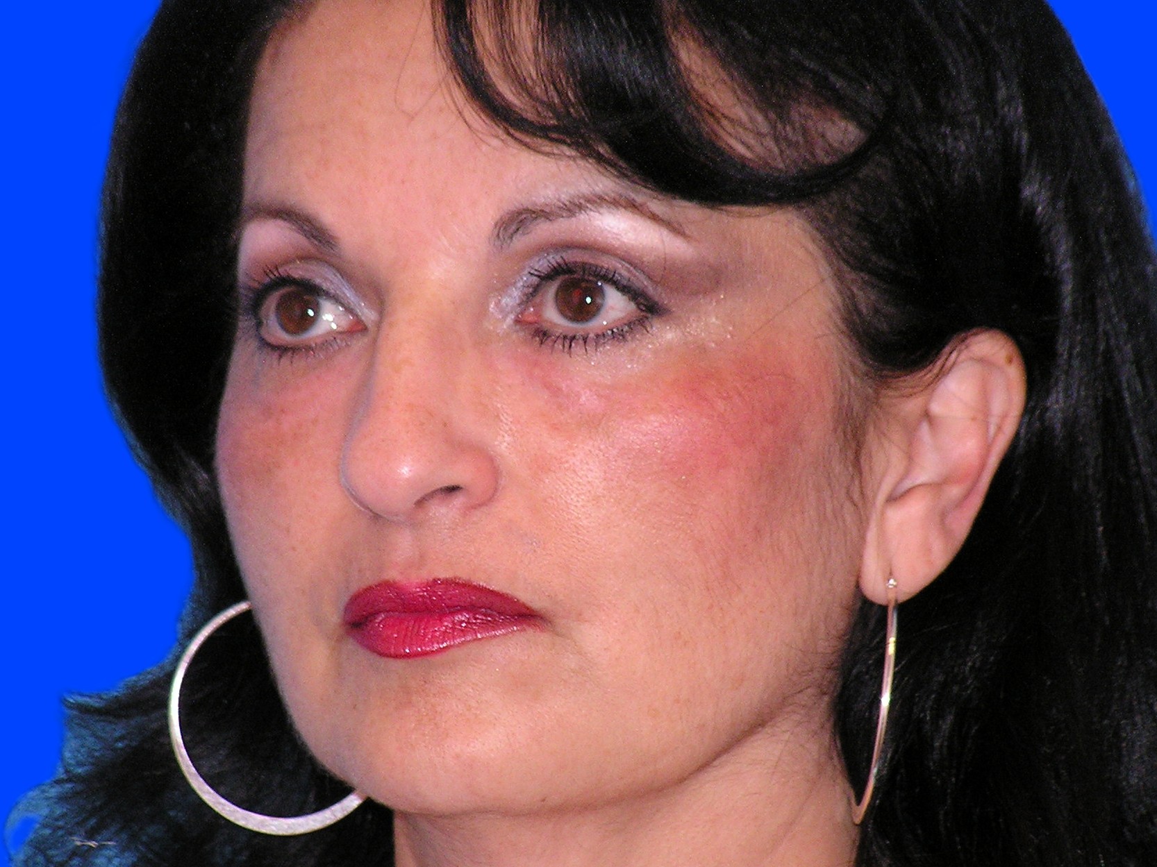 After Image: Patient Case #55 - left-front-oblique