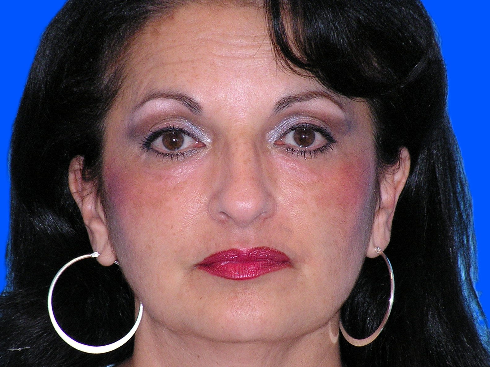 After Image: Patient Case #55 - front