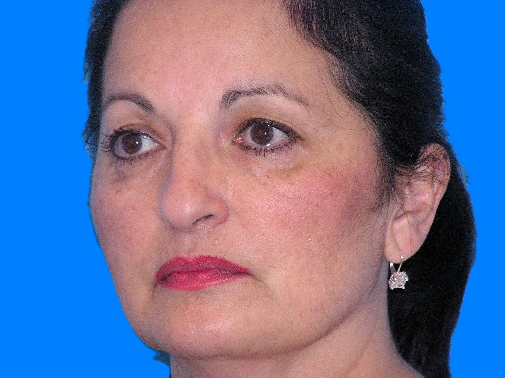 Before Image: Patient Case #55 - left-front-oblique