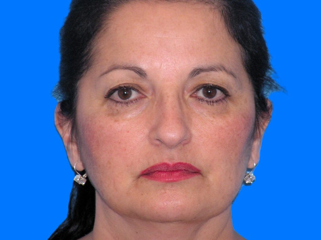 Before Image: Patient Case #55 - front