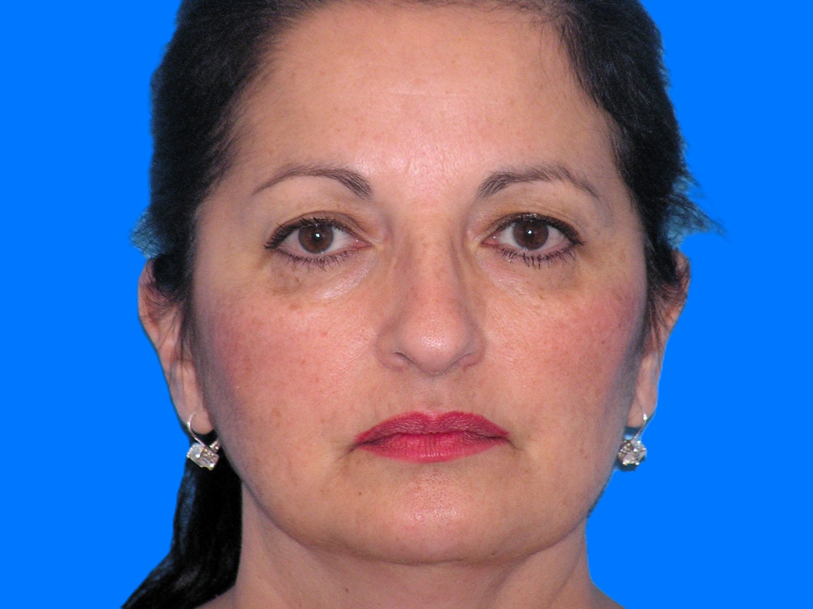 Before Image: Patient Case #55 - front