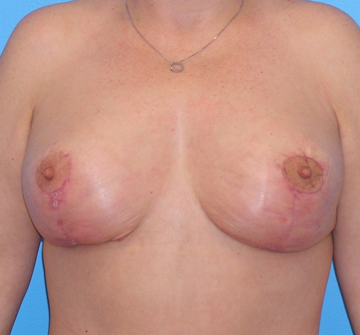 After Image: Patient Case #580 - front