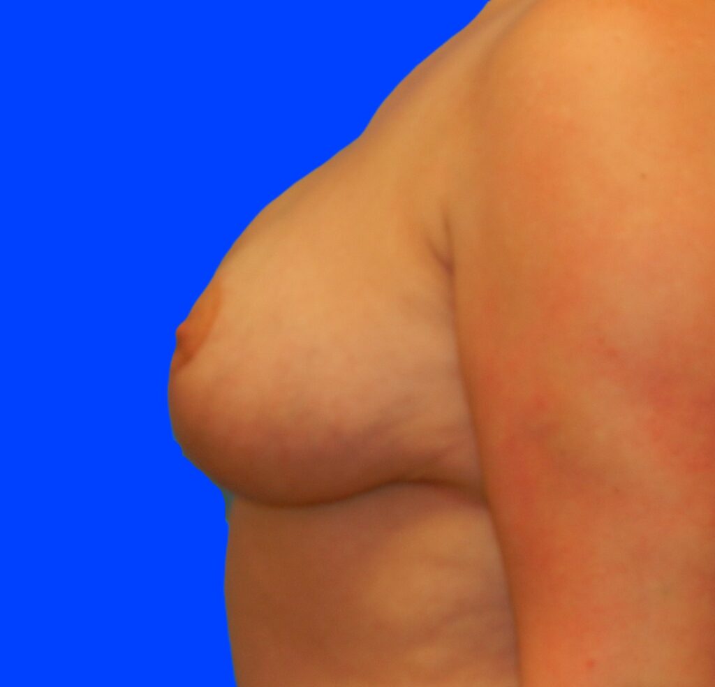 After Image: Patient Case #653 - left-side