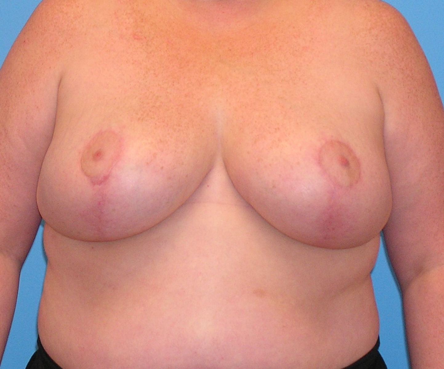 After Image: Patient Case #656 - front