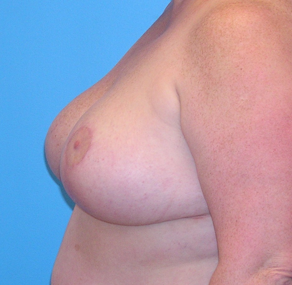 After Image: Patient Case #656 - left-side