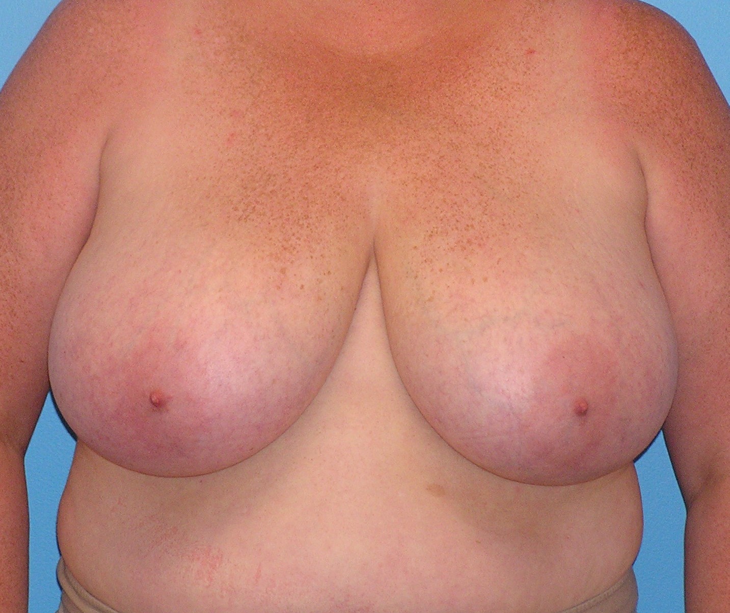 Before Image: Patient Case #656 - front