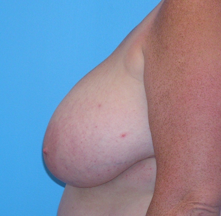 Before Image: Patient Case #656 - left-side