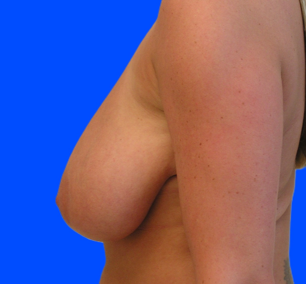 Before Image: Patient Case #657 - left-side