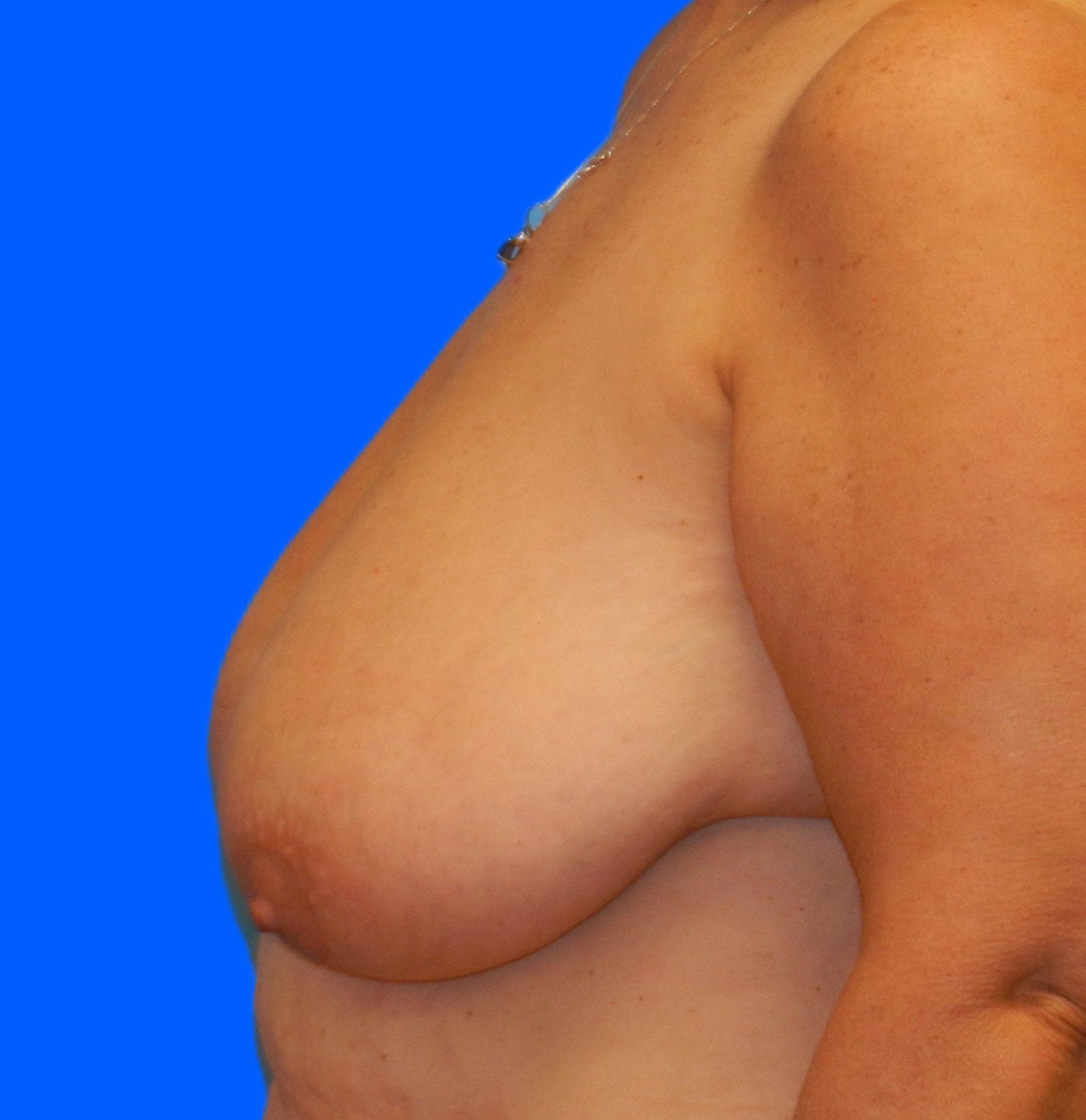 Before Image: Patient Case #661 - left-side