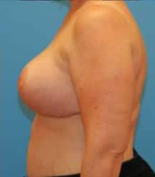 After Image: Patient Case #663 - left-side