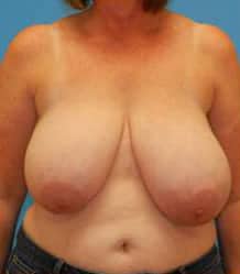 Before Image: Patient Case #663 - front