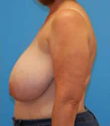 Before Image: Patient Case #663 - left-side