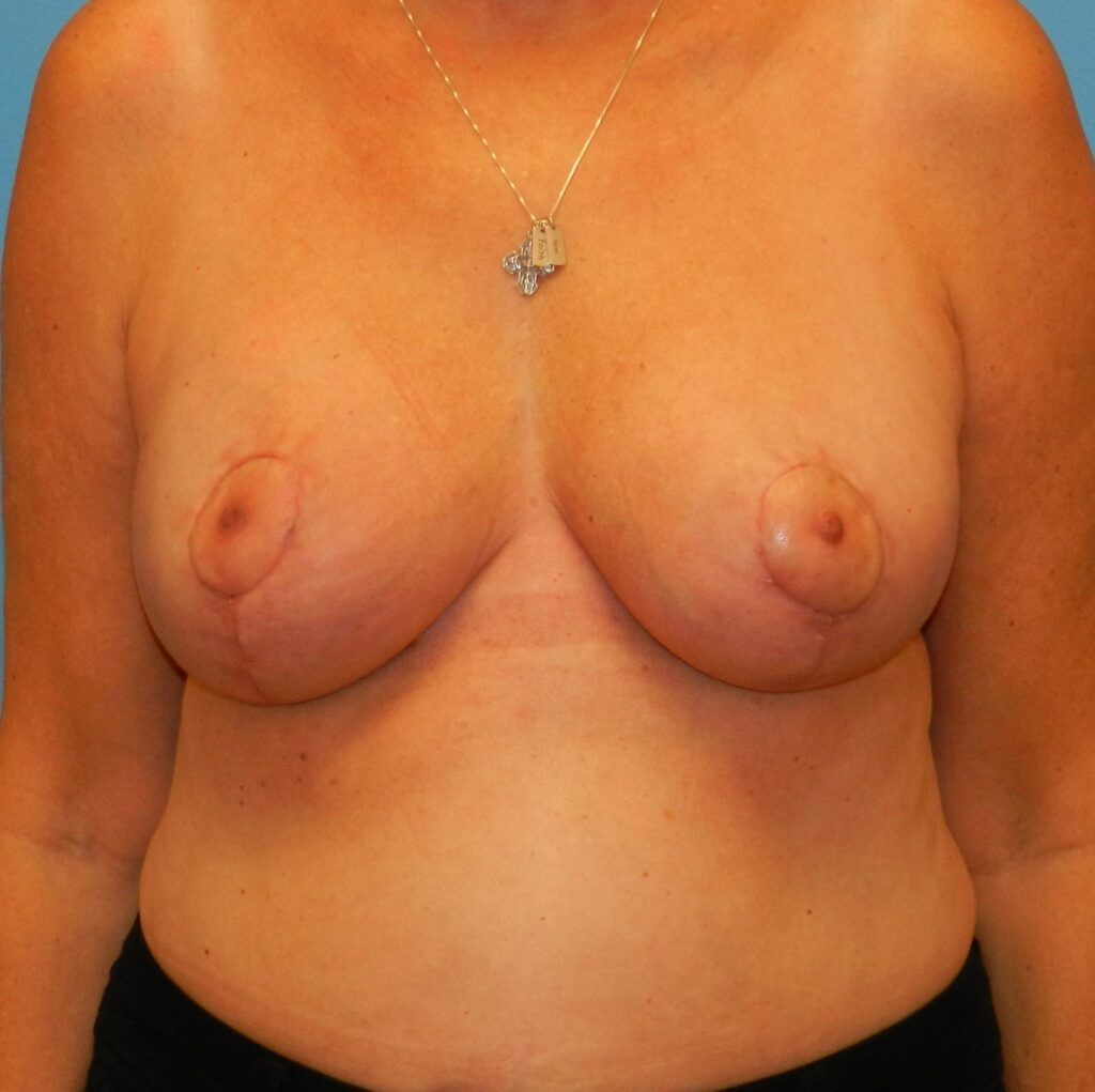 After Image: Patient Case #666 - front