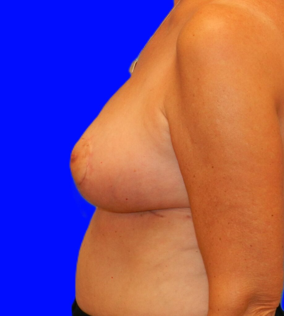 After Image: Patient Case #666 - left-side