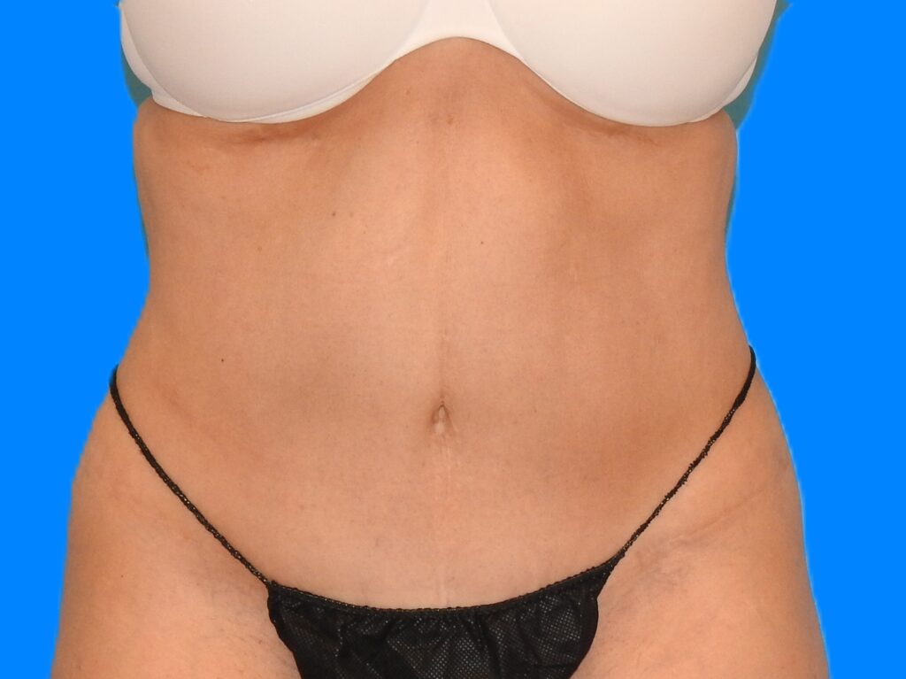 After Image: Patient Case #785 - front