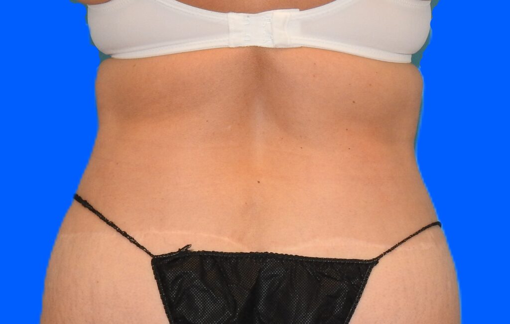 After Image: Patient Case #785 - back
