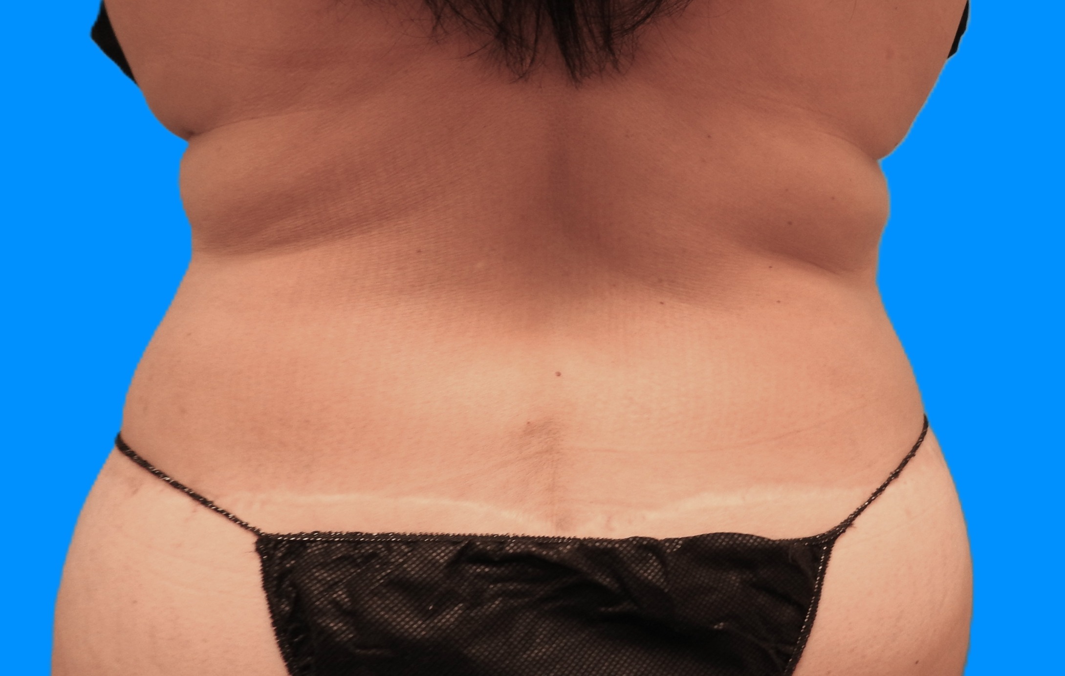 Before Image: Patient Case #785 - back