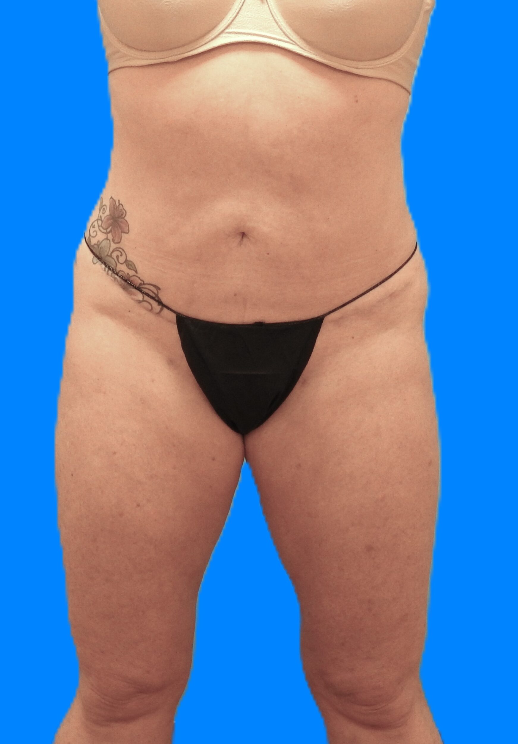 After Image: Patient Case #786 - front