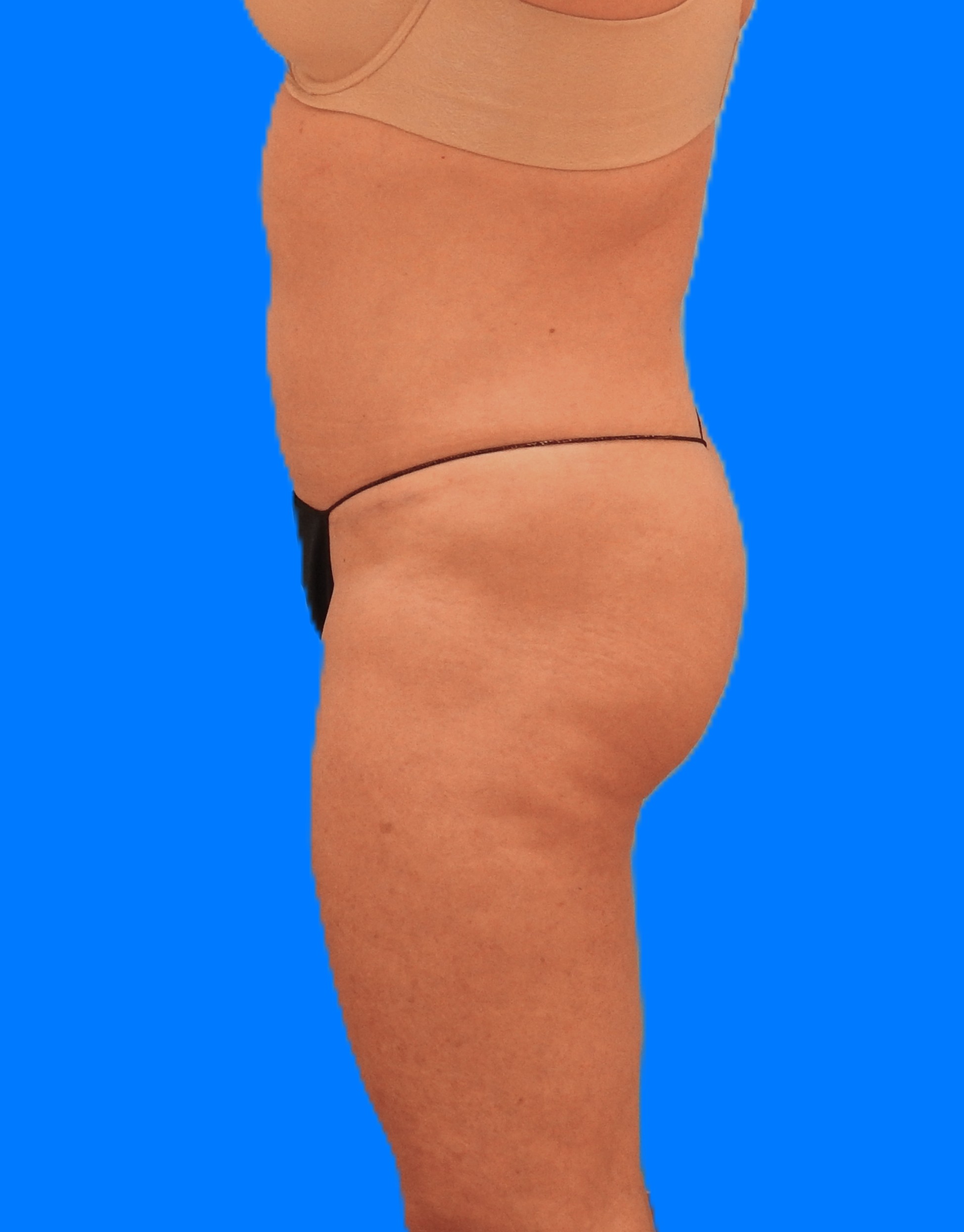 After Image: Patient Case #786 - left-side