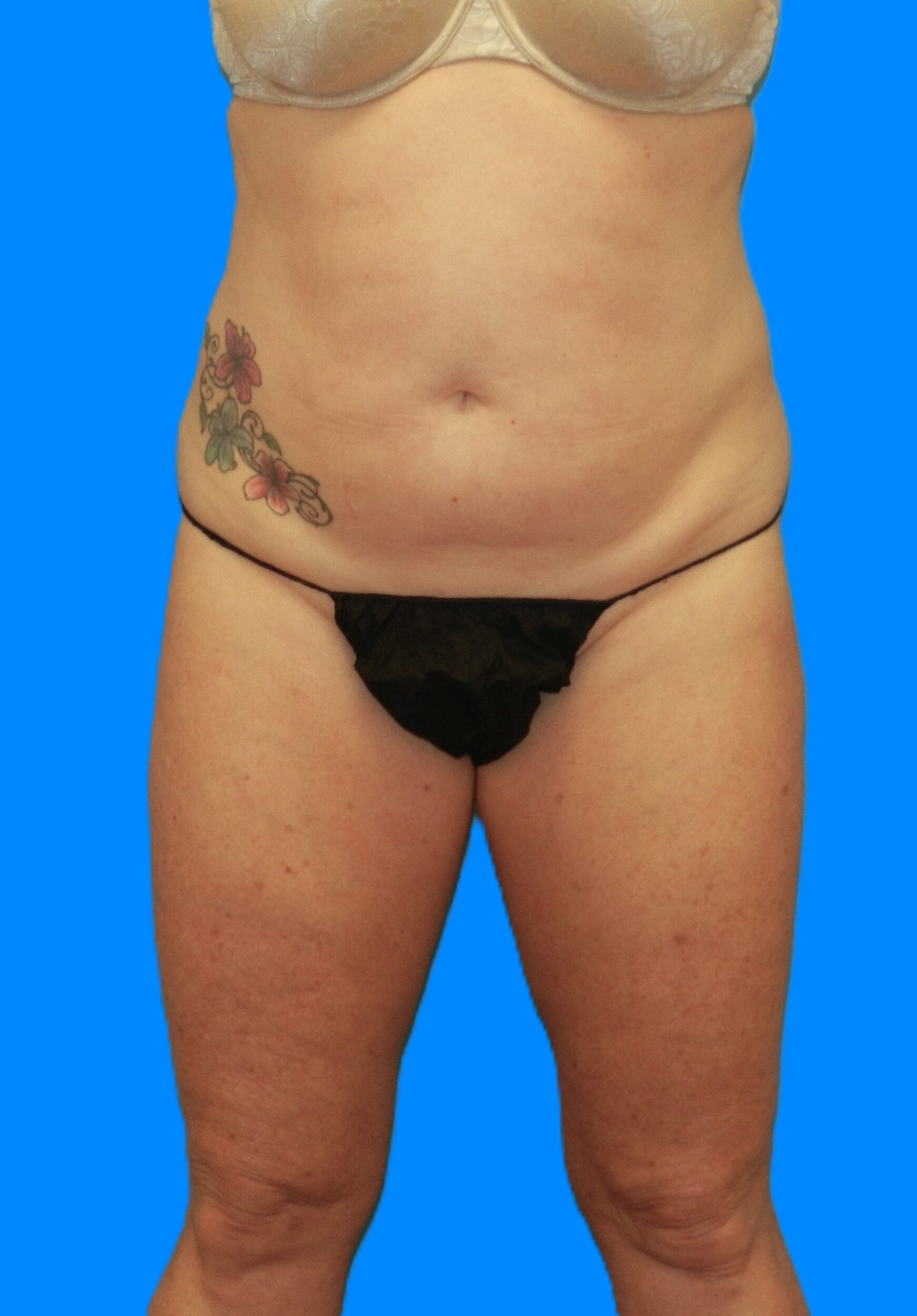 Before Image: Patient Case #786 - front