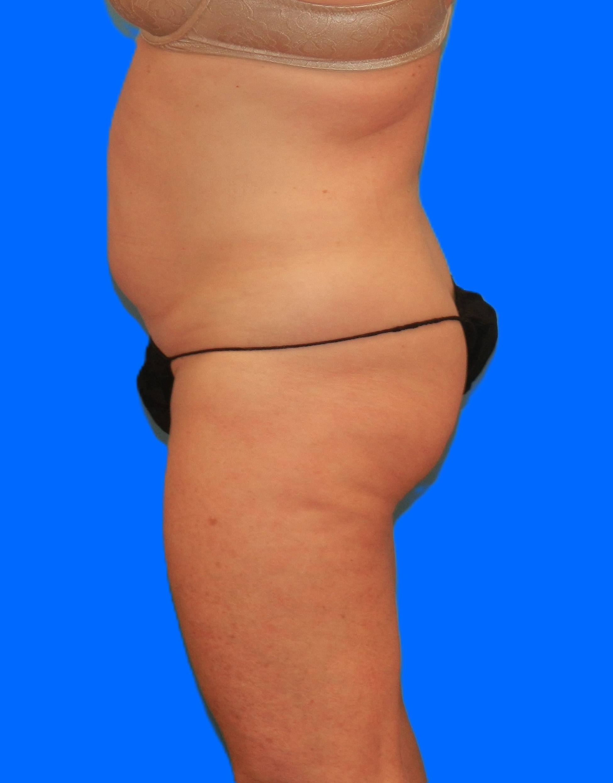 Before Image: Patient Case #786 - left-side