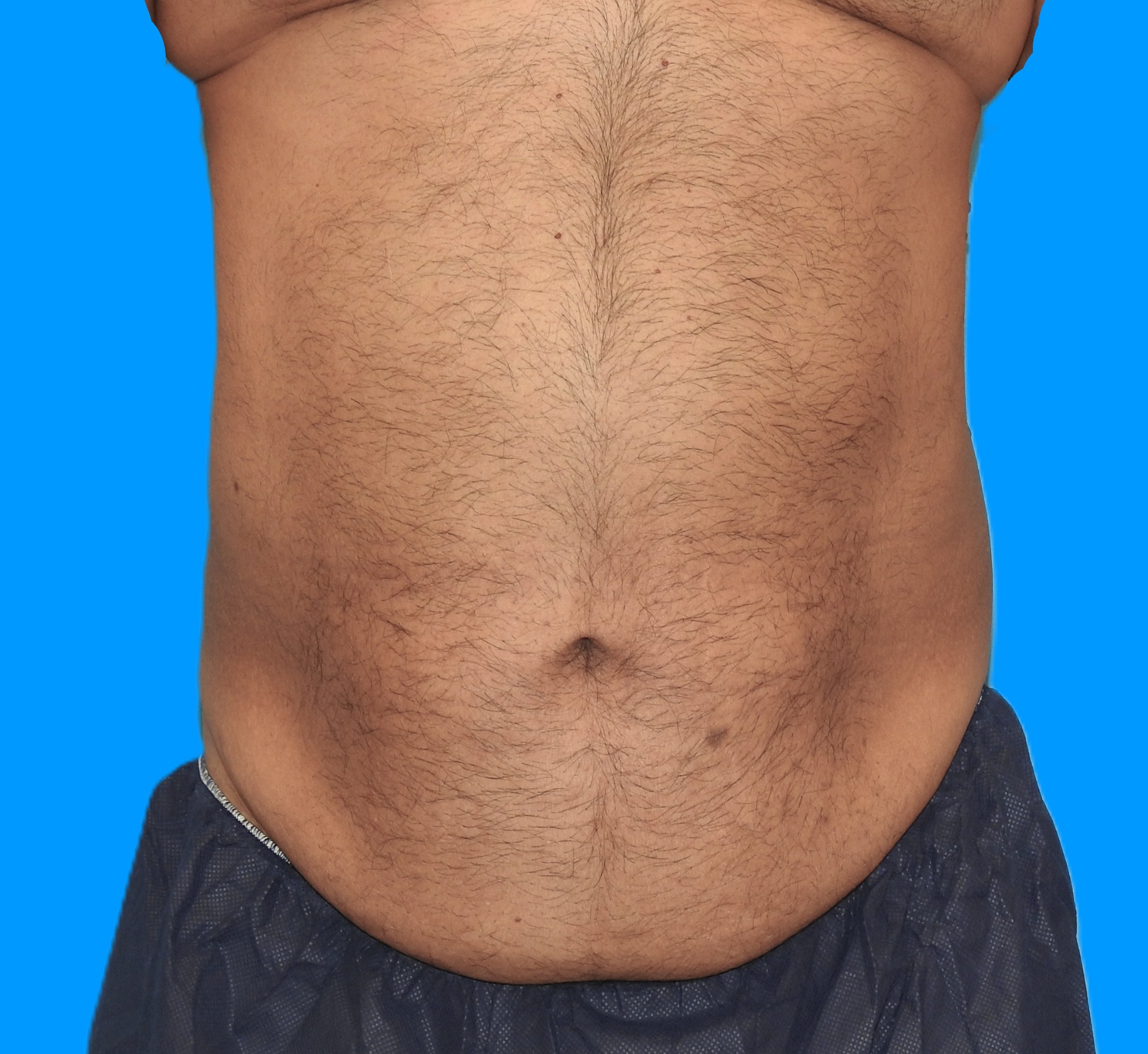 After Image: Patient Case #787 - front