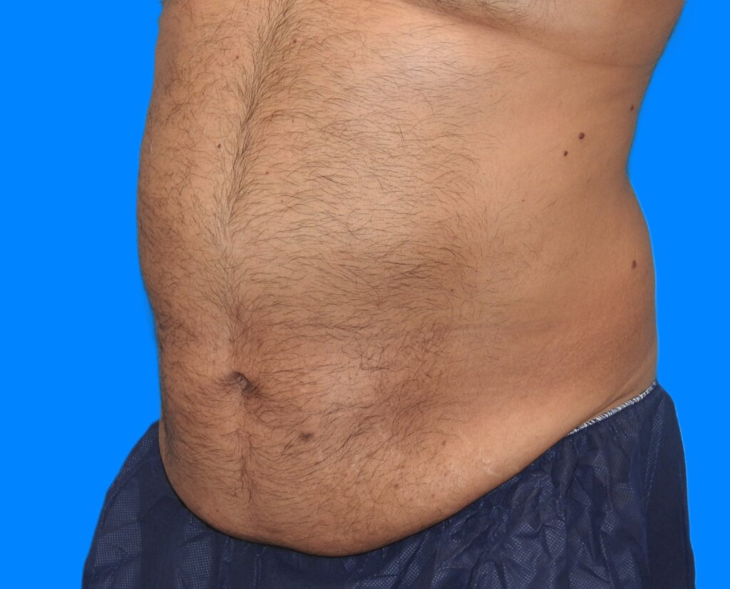 After Image: Patient Case #787 - left-front-oblique