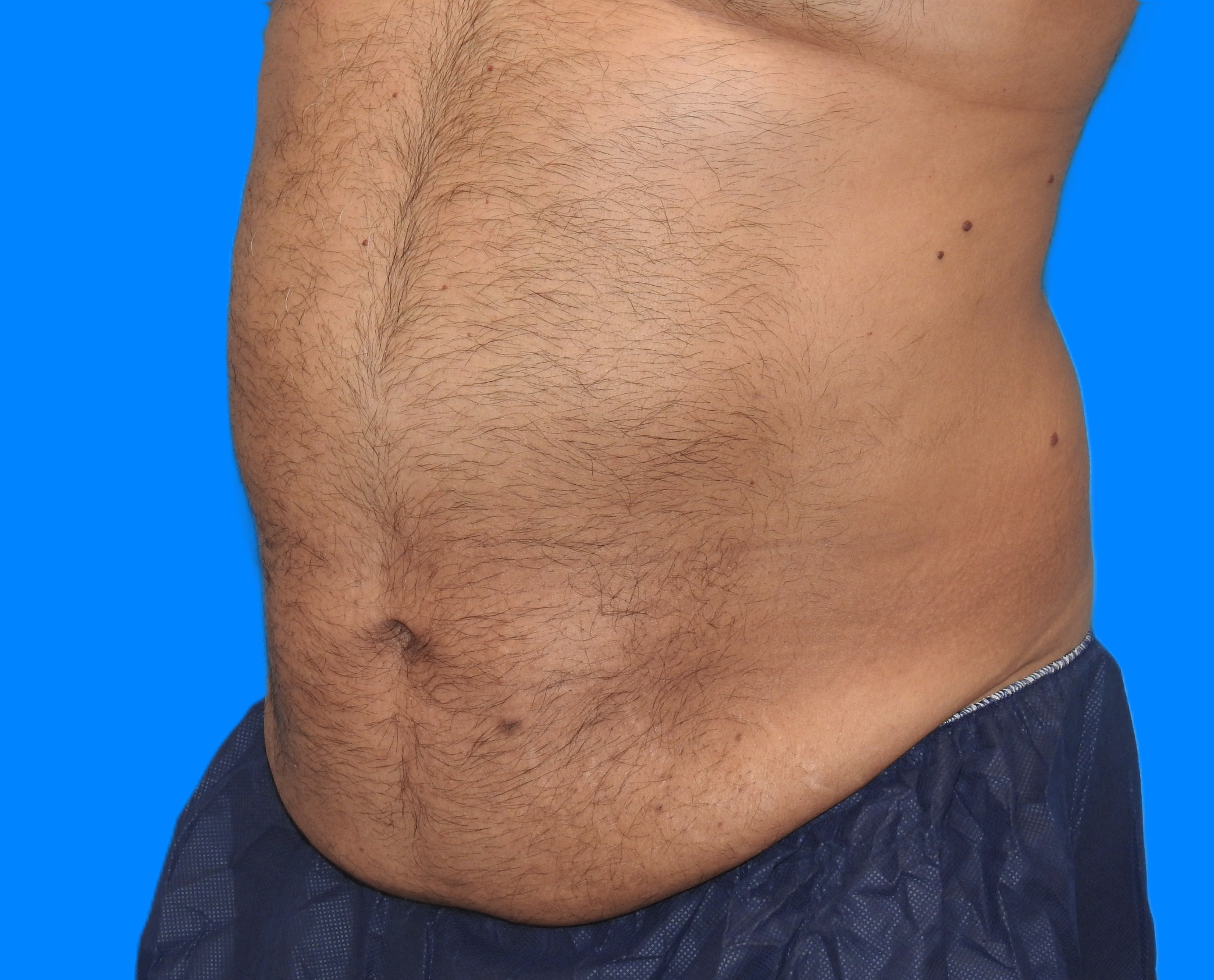 After Image: Patient Case #787 - left-front-oblique