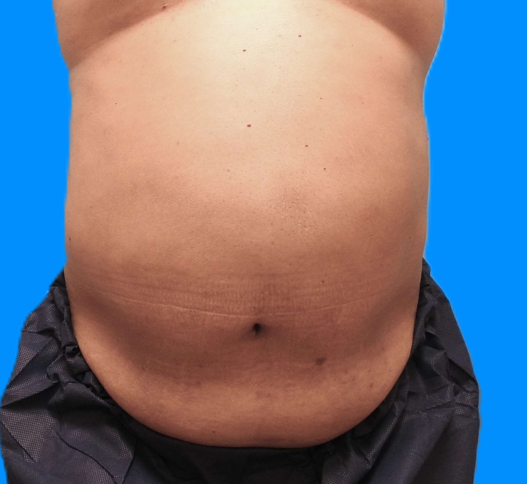 Before Image: Patient Case #787 - front