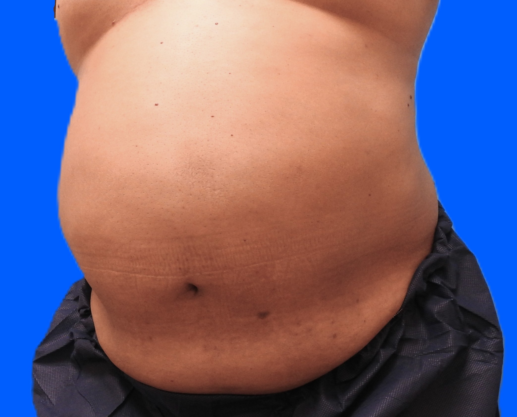 Before Image: Patient Case #787 - left-front-oblique