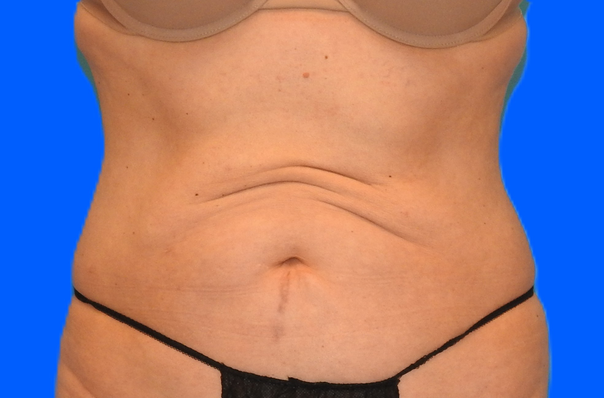 After Image: Patient Case #793 - front