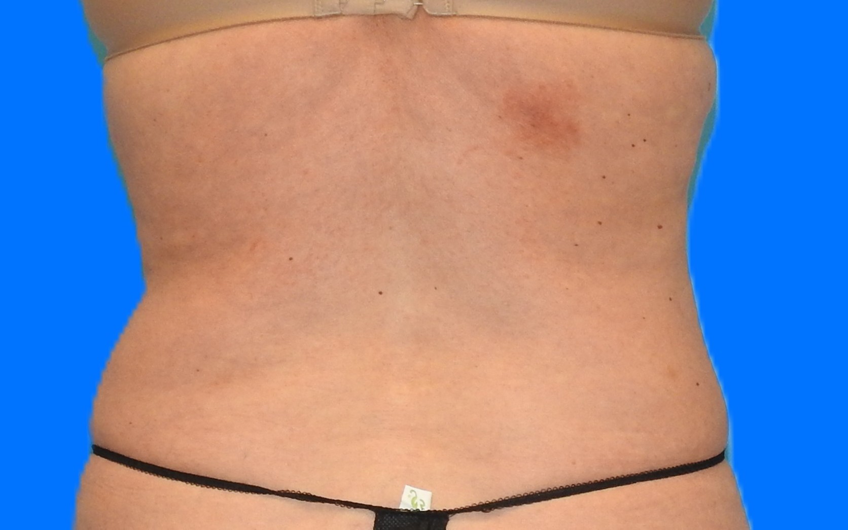 After Image: Patient Case #793 - back