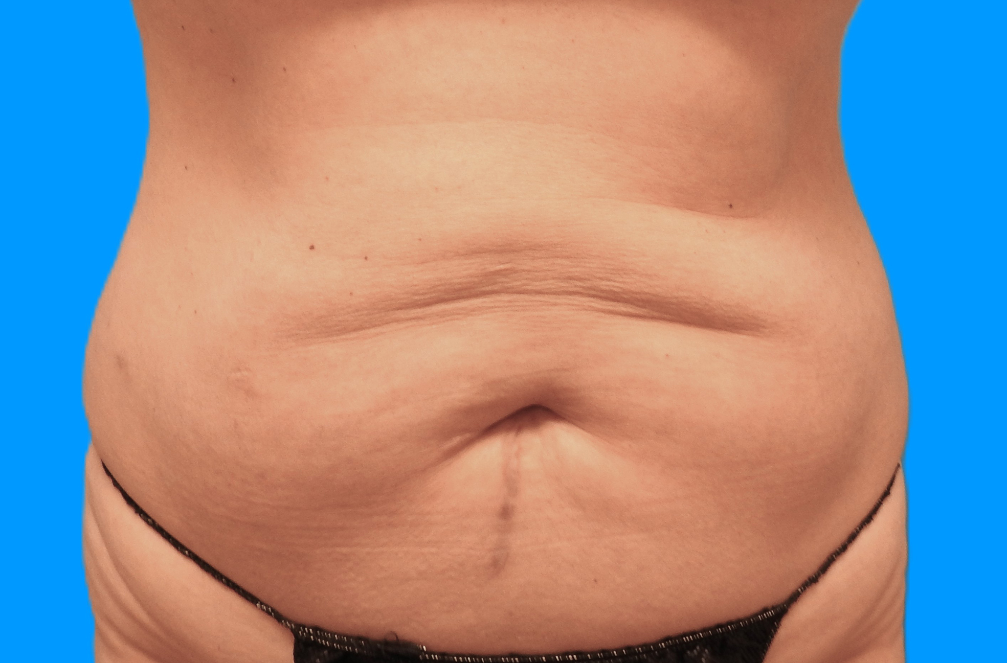 Before Image: Patient Case #793 - front