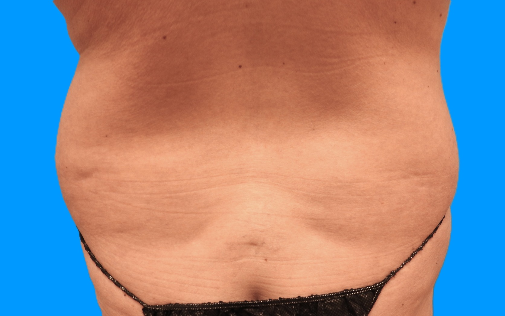 Before Image: Patient Case #793 - back