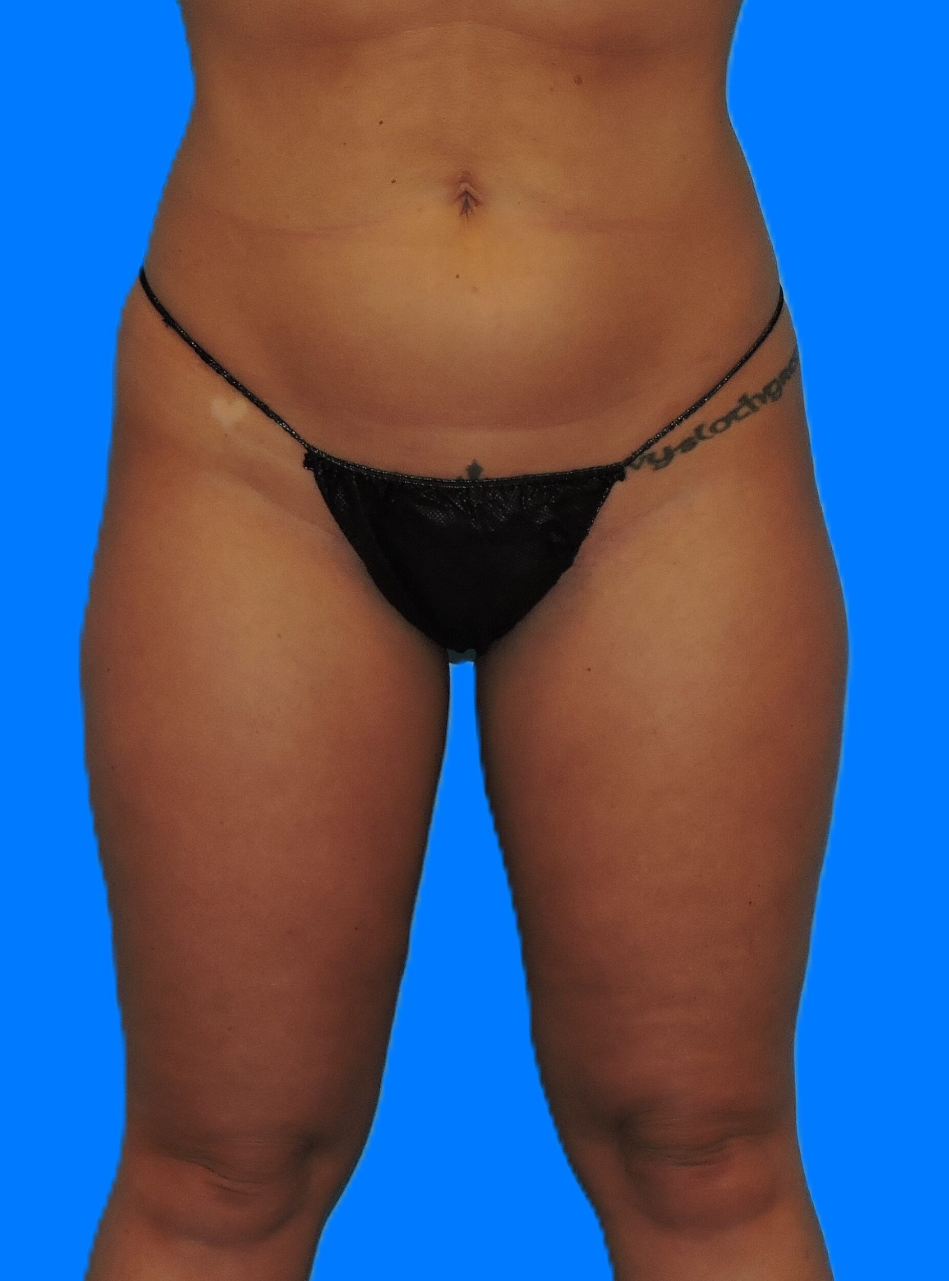 After Image: Patient Case #794 - front