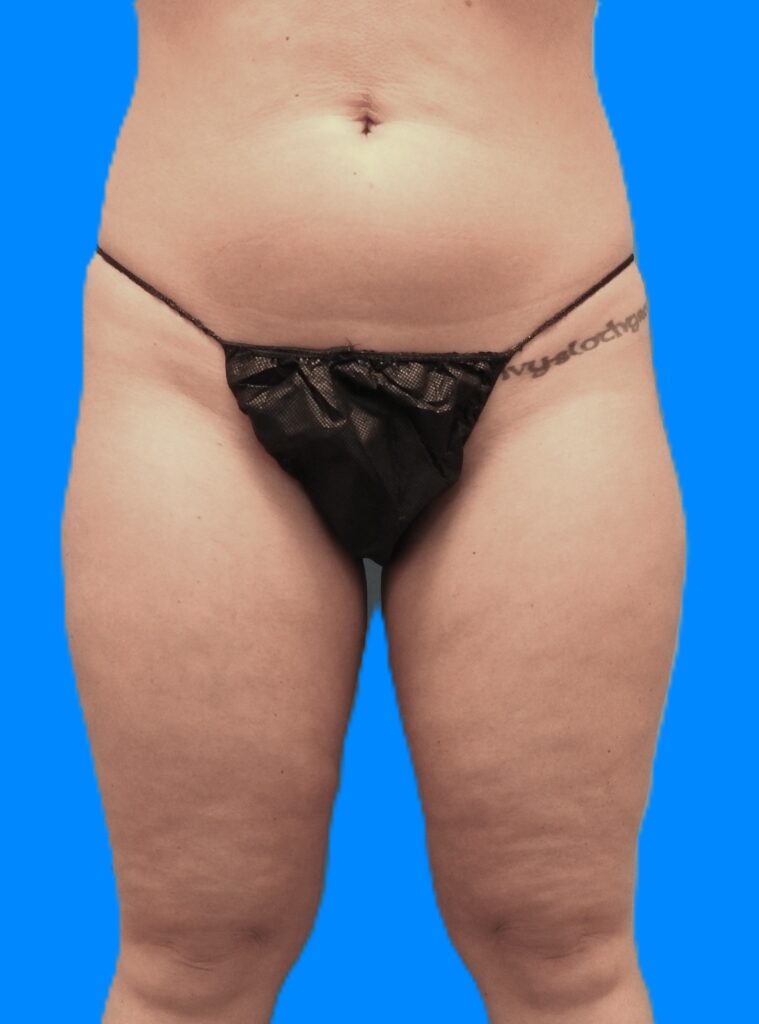 Before Image: Patient Case #794 - front