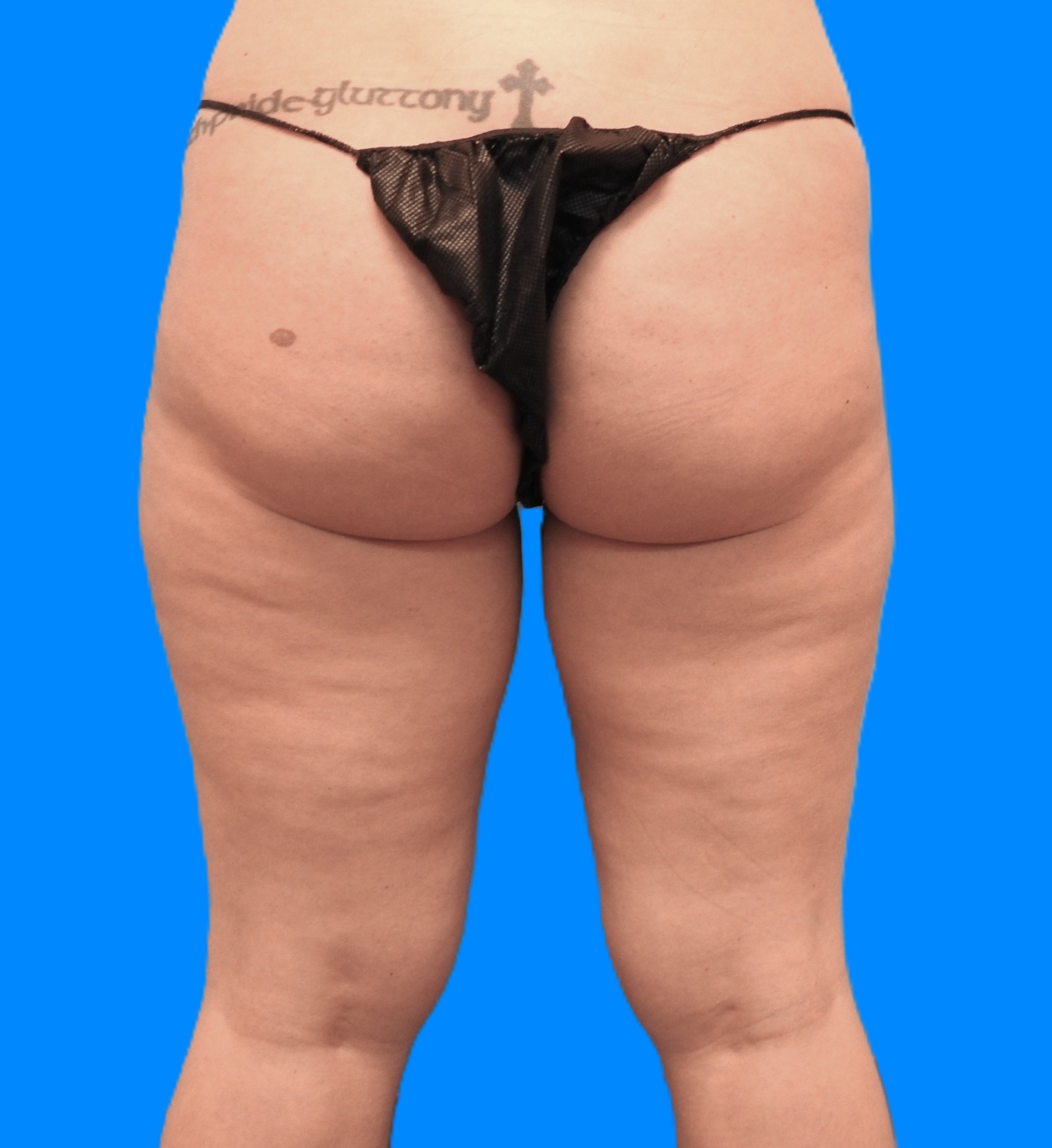 Before Image: Patient Case #794 - back