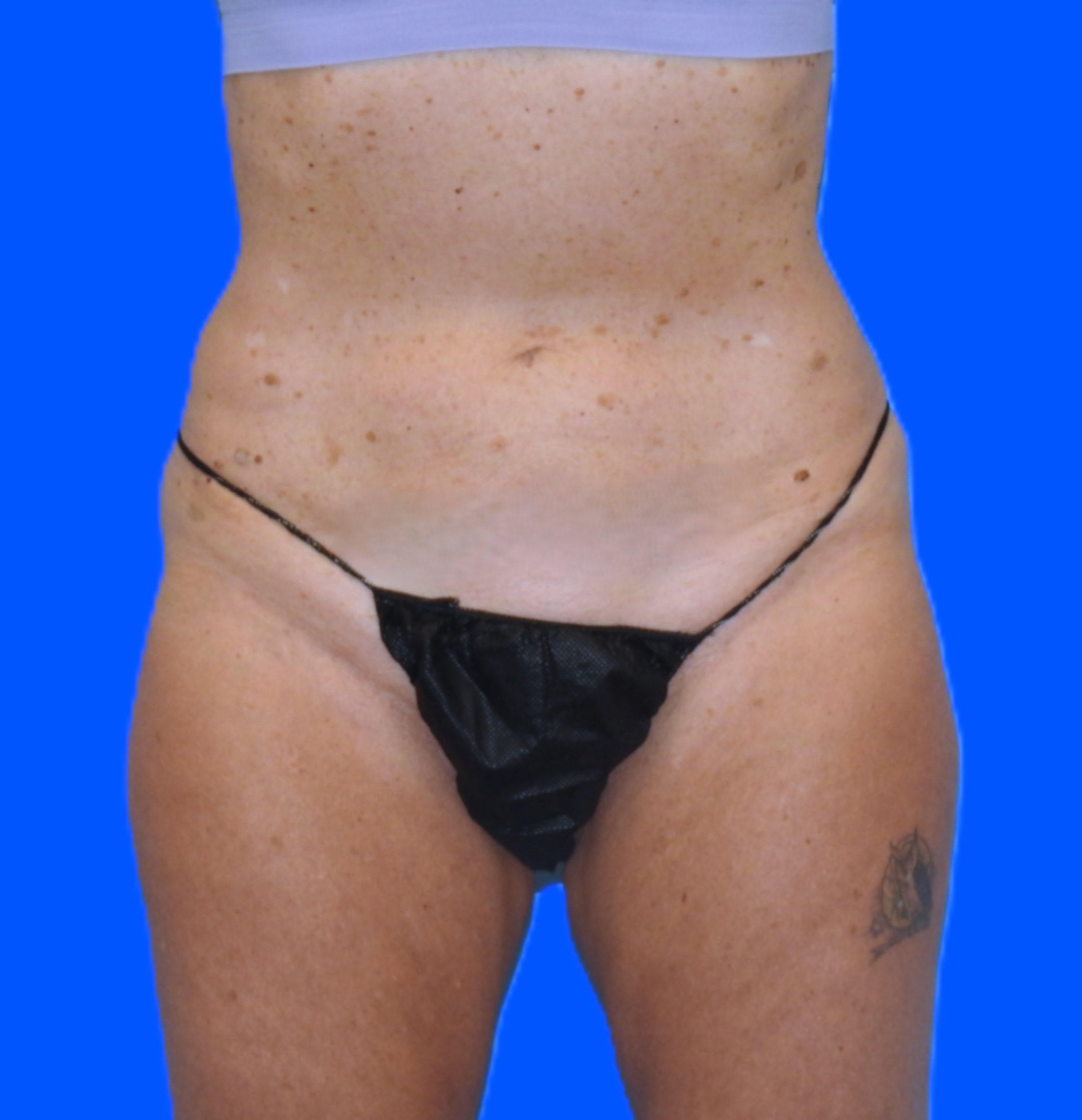 After Image: Patient Case #795 - front